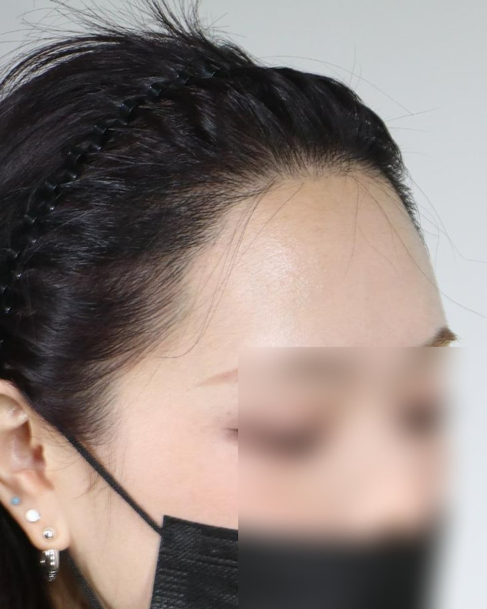 수술 후, 관자놀이까지 자연스럽게 이어진 같은 분의 측면 헤어라인