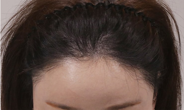 여성 헤어라인 재수술 · 1,800모 · 정면 · 모우림 재수술 1년 뒤