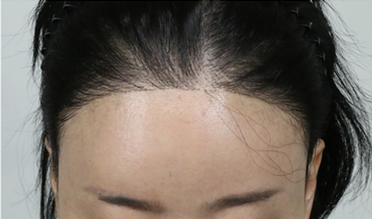 여성 헤어라인 재수술 · 1,800모 · 정면 · 1차 수술 5년 뒤