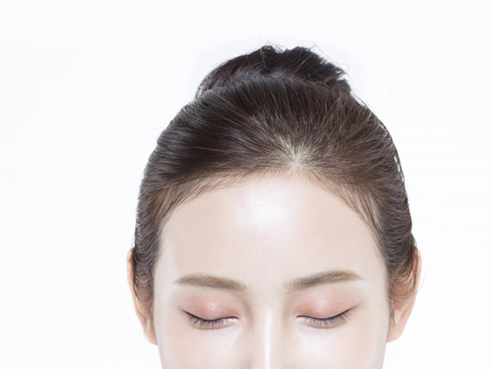 헤어라인 교정을 받은 여성의 옆모습