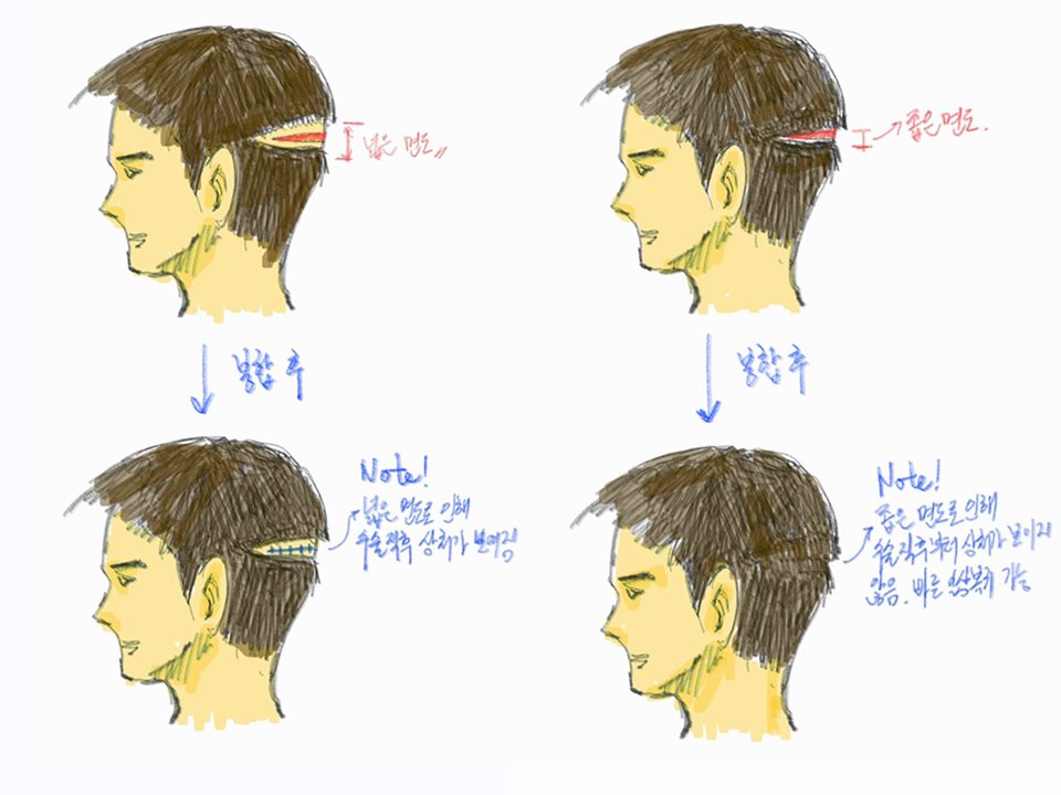ภาพวาดอธิบายขอบเขตการโกนที่น้อยที่สุด