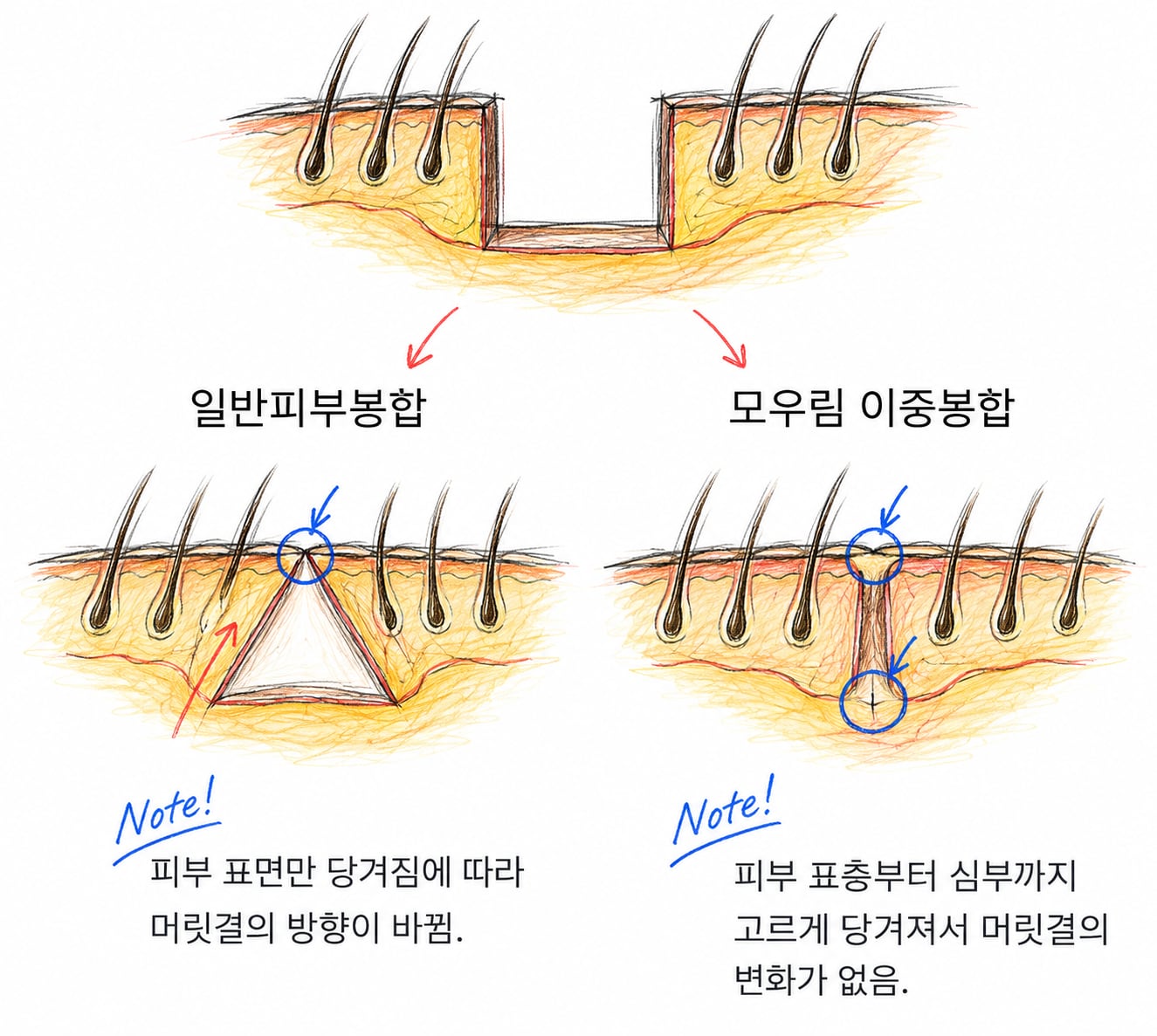 표면만 봉합하면 머릿결 방향이 바뀌고 이중 봉합은 그대로 유지되는 것을 비교한 단면도