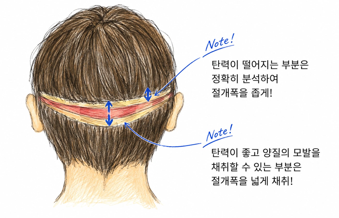 후두부 탄력에 따라 절개 폭을 부위별로 달리하는 채취 영역 그림