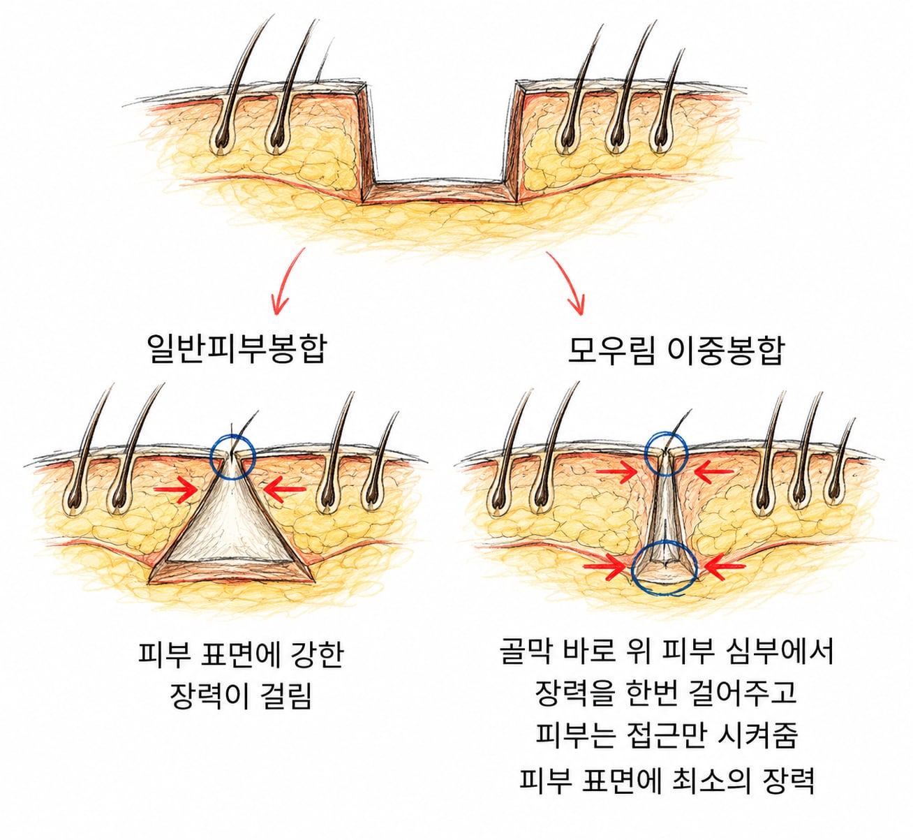일반 피부 봉합과 모우림 이중 봉합의 장력 차이를 비교한 단면도