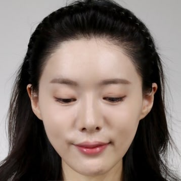 바카스 수술 후