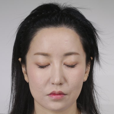 AFTER Gyubi FUE · ด้านหน้า 4,000 กราฟต์ · ปรับแนวผม