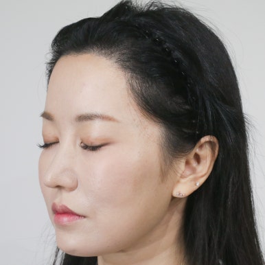 AFTER Gyubi FUE · ด้านข้าง 4,000 กราฟต์ · ปรับแนวผม