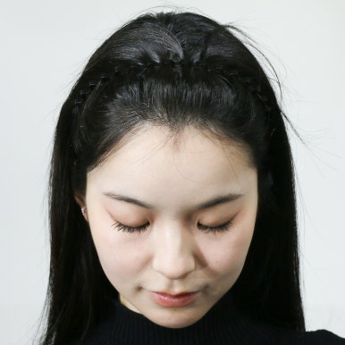 AFTER Yuna FUE box cut · ด้านหน้า 1,300 กราฟต์ · ปรับแนวผม